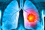 Targeted Therapy: A New Hope for Lung Cancer Patients