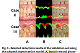 Brief Review — Accuracy of Artificial Intelligence-Based Photographic Detection of Gingivitis
