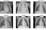 Pneumonia Detection From X-ray Images Using Deep Learning Neural Network