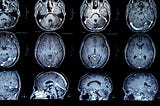 Glioblastoma brain tumor segmentation — Part 2 — Exploratory Data Analysis