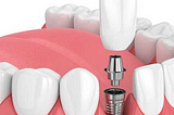 Why Dental Implant Services Are The Best Solution For Missing Teeth?