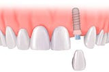 Dental Implants in Essex