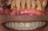 All-on-4/6 Same-day Implants