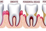 Understanding Gum Disease