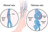 Leading Lymphedema Therapy Clinic in MN | Minnesota Vein Center