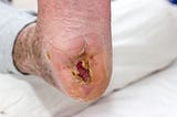 Here’s Why Diabetic Foot Ulcers Remain An Existential Threat For Diabetics — Even When Using…