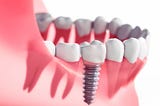 Dental Implants in Rio Rancho