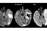 Using CNNs to Improve Brain Tumor Segmentation Accuracy.