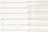 How a Silent Heart Disturbance May Signal You Have Sleep Apnea