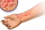 Hives ( Urticaria )