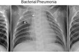 Pneumonia Diagnosis using CNN’s
