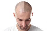 Top Non-Surgical Hair Restoration Techniques Available in Concord