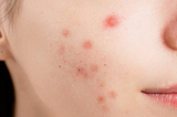 Sudden Active Acne: What You Need to Know | Skin Solution 1O1