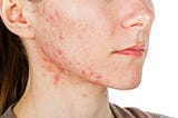 Nodular Acne: Causes, Symptoms, and Treatment Options for Clearer Skin