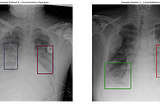 Pneumonia Detection from chest radiograph (CXR)