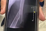 I snapped my femur rock climbing, now what?