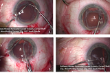 Micro Instruments That Facilitate Fibrorhexis Technique and Late IOL Explantation