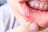 Top 3 mouth ulcer treatments