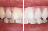 Teeth Whitening in Miami Springs, FL : Apple Dental Group