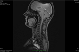 Functional MRI for Major Depressive Disorder