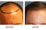 Hair Loss Clinic in LA