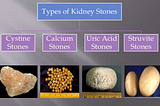 A Quick Guide On Kidney Stones And Their Types