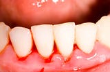 How to stop gums from bleeding?