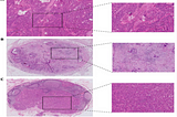 Stroma-High Lymph Node Involvement Predicts Poor Survival More Accurately for Patients with Stage…