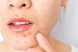 Acne: 5 natural tips to make your pimples disappear.