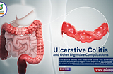 Ulcerative Colitis and Other Digestive Complications