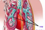 Stage 4 Mesothelioma Cancer Symptoms