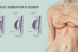 breast-augmentation-ahmet-dilber