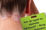 How psoriasis of scalp will affect you?