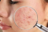 A Gynecologist/Cosmetic Surgeon Tells Why Your Acne Medicine Is Not Working: And How To Fix It