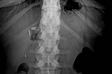 An x-ray from behind of my mid-spine, showing four clips and slight curvature