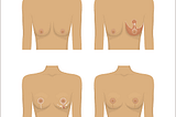 What Does a Breast Lift Look Like?