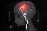 What causes a stroke and why does it happen? [Infographic]