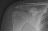 Psychosomatic Aspects of Frozen Shoulder