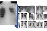 COVID-19 Case Study with CNN