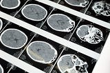 AI in Healthcare: Using DL and TL to Locate Tumors in Brain Scans