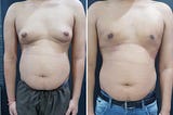 Choosing the Right Surgeon for Your Gynecomastia Procedure