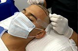 Advantages of hair transplant with the FUE technique
