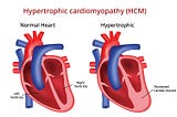 Hypertrophic Cardiomyopathy — then, now and the hidden pioneers