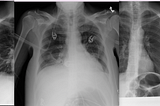Multi-category classification of various chest conditions from chest x-rays