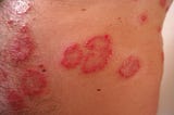 How to Actually HEAL Inflammation Instead of Living Fast, Fat & Dying Young