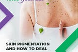 Skin pigmentation and how to fight it