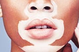 What is Solution to Lip Vitiligo?