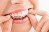 The Ultimate Guide to Straightening Teeth Effortlessly: Invisalign in Maspeth