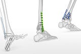 The Unknown Facts Regarding Orthopedic Implants Material