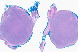 Angiolymphoid Hyperplasia with Eosinophilia